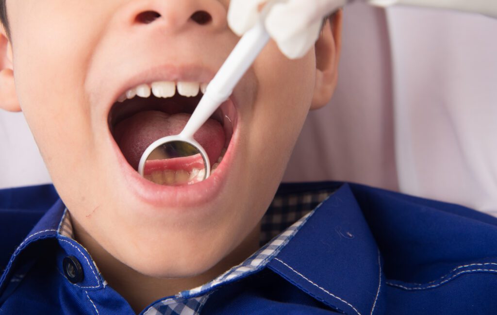 Tooth Extractions for Kids