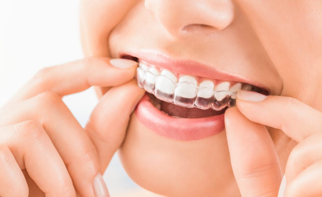 Invisalign Candidate Worcester MA