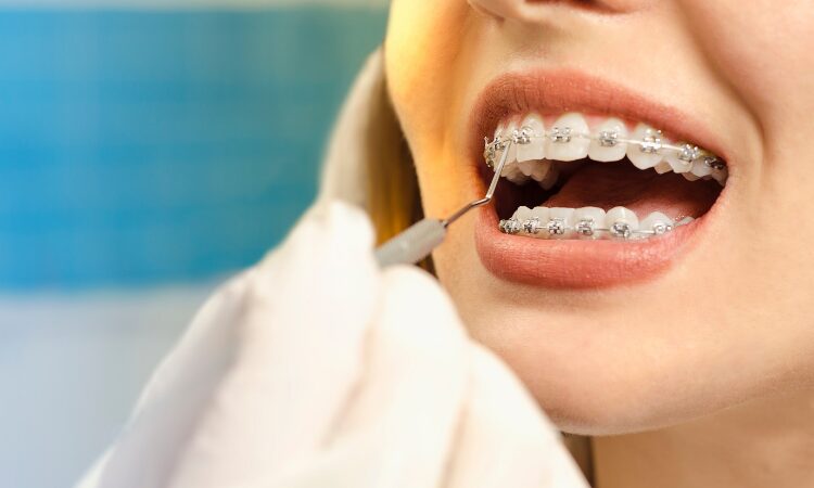 Maintaining oral hygiene with braces is crucial to prevent long-term dental issues and ensure successful orthodontic treatment.